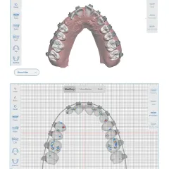 Fully-Customized Precision Braces